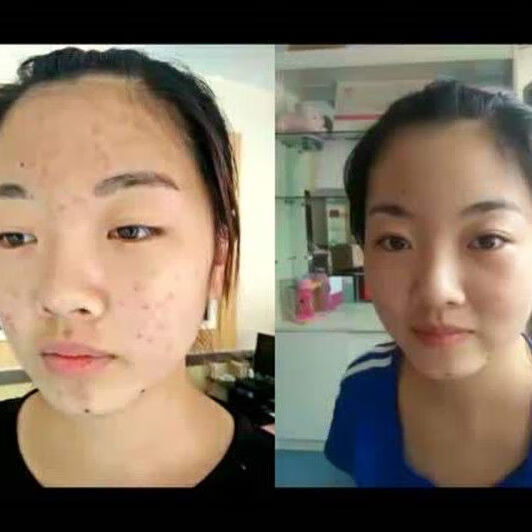 lism小白瓶祛痘膏痘青春痘坑淡化痘印闭合粉刺修复霜 新版本