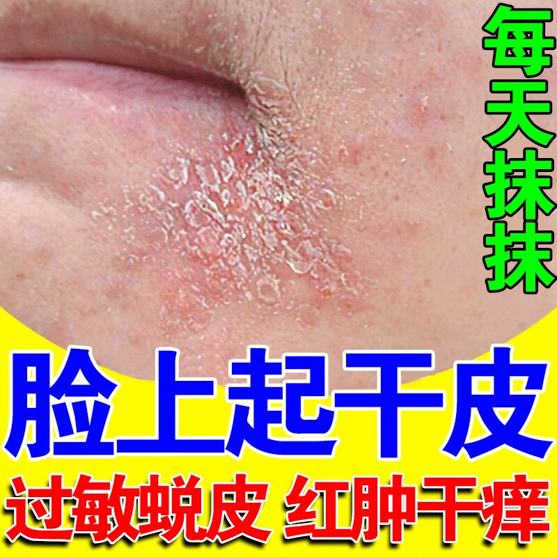 【官方百亿贴】脸上起癣皮肤干燥起皮长癣干燥脱皮过敏红痒眼皮癣 单