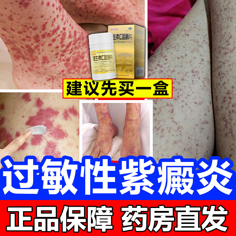紫癜性皮炎 过敏性紫癜的治疗药辅助用药全身红色瘀斑血斑血点 紫癜药