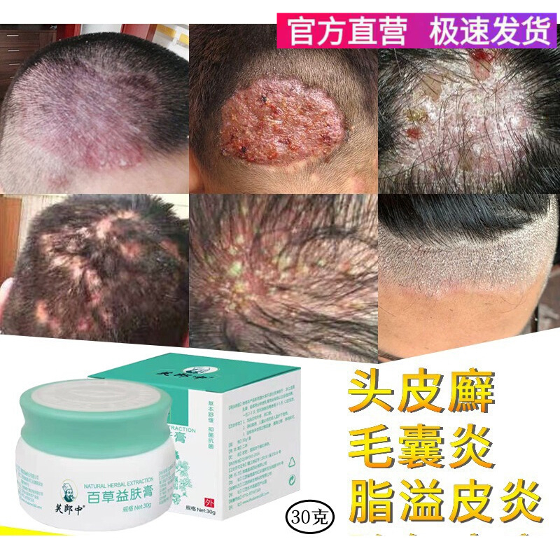 毛囊炎 背部 头部头皮身体脸部私处头上长 疙瘩 痘痘克星 专用膏
