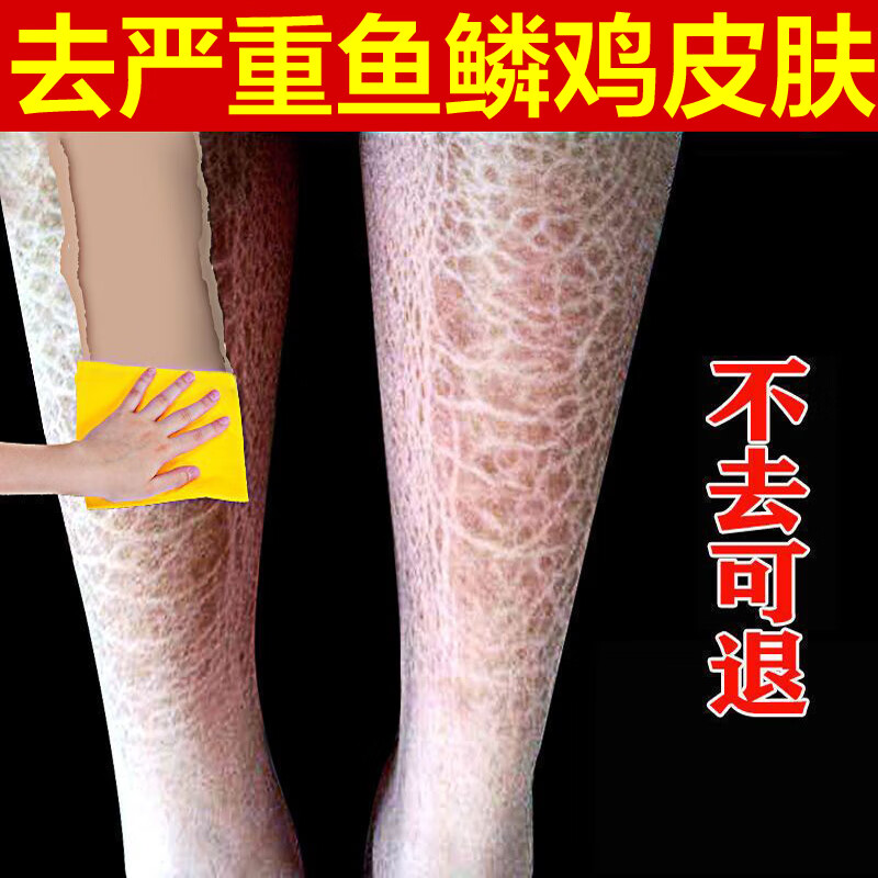k&p鸡皮疙瘩去除身体乳鱼鳞皮肤霜蛇皮膏去蛇皮鱼鳞皮肤蛇皮腿祛