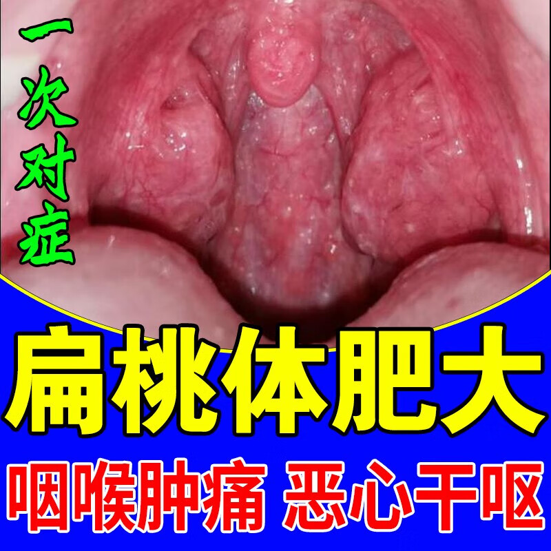扁桃体肥大肿大治疗儿童急慢性咽炎咳嗽发炎打鼾咽喉肿痛发炎干痒专用