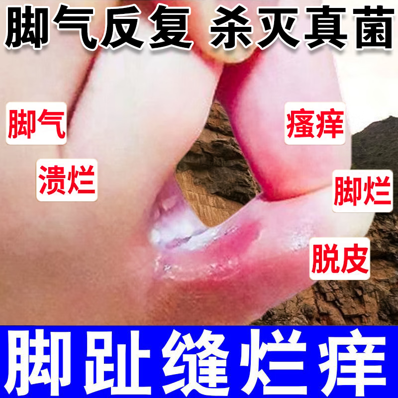 感染糜烂型脚气脚趾缝溃烂痒臭治脚气足癣的药嘉效盐酸特比萘芬乳膏 2