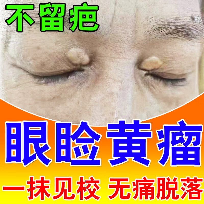 去除睑黄疣药膏眼睑黄色瘤专用脂肪粒汗管瘤眼部每瓶20ml【jd大药房
