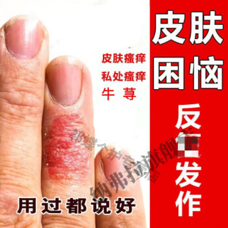 妍肤(yanfu) 妍肤 硫磺软膏疥l疮瘙痒小水泡毛囊l焱l湿l疹丘l疹红l斑l