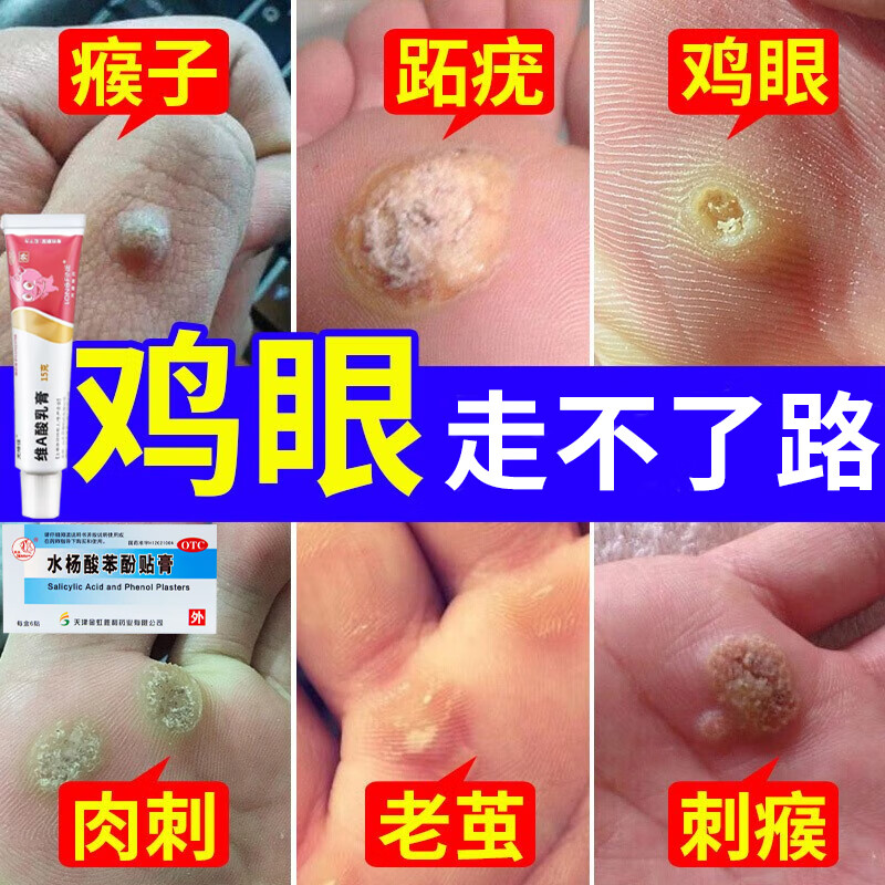 鸡眼膏 去看肉刺药膏 成人脚底脚趾鸡眼跖疣瘊子老茧走路疼痛软化角质