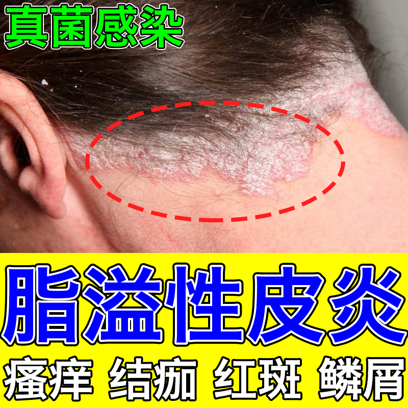 硫软膏 头皮痒脂溢性皮炎专用otc药头屑头皮癣头痒真菌感染头皮癣专用