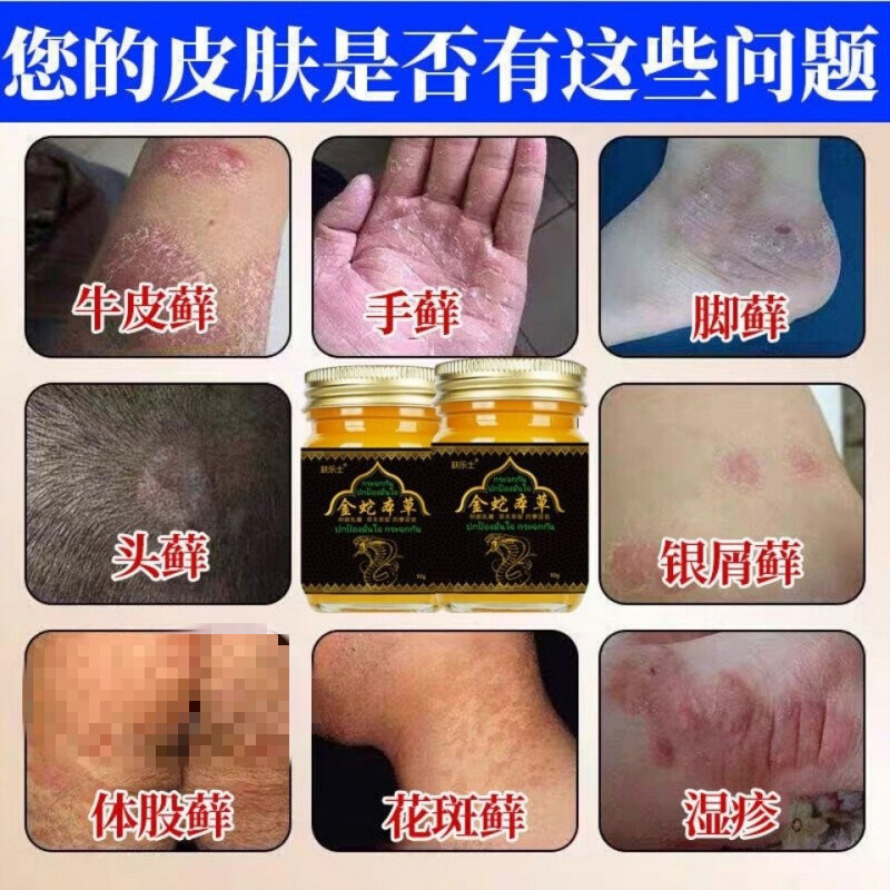 泰国配方牛廯l病各种皮l廯阴囊潮湿私密处瘙痒大腿内侧过敏性皮肤瘙痒