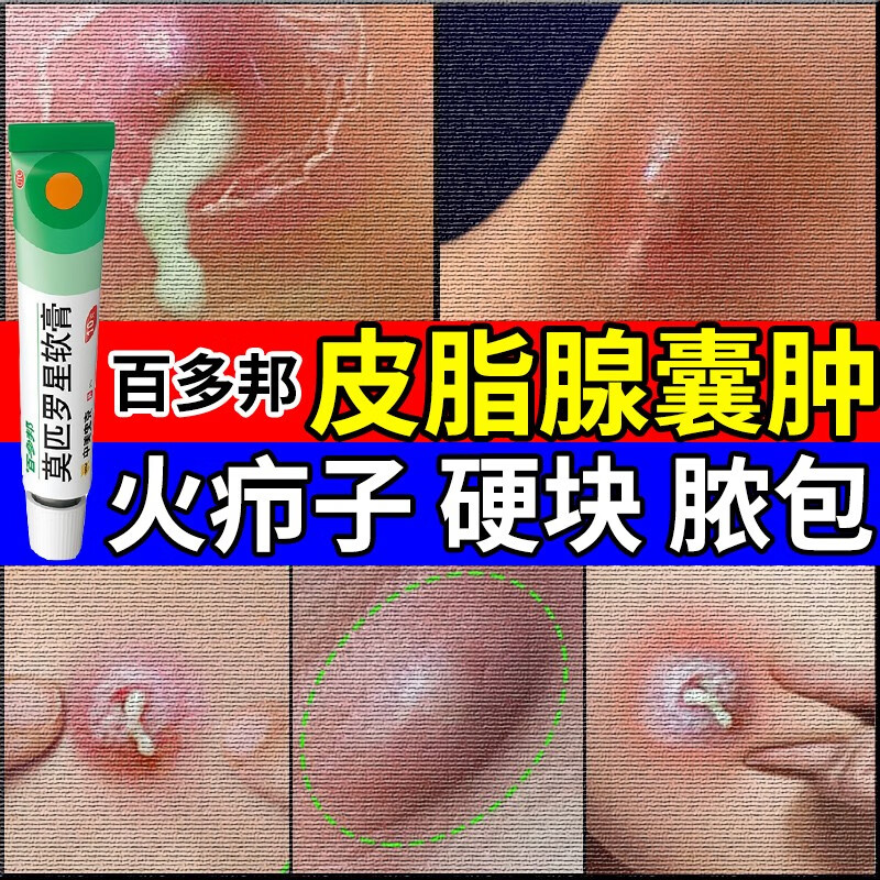 皮脂腺囊肿药膏 抗生素软膏药治囊肿性痤疮痘痘硬块脓包瘙痒疼痛