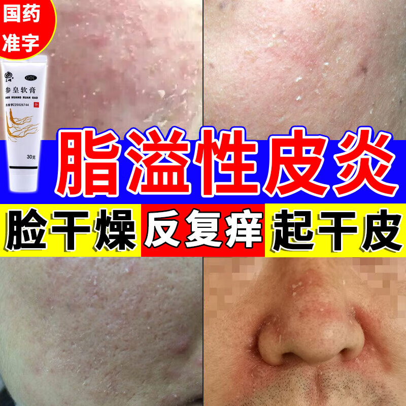 四季皮肤干燥脱皮有碎屑过敏红痒油腻消炎止痒专用药养血润燥参皇软膏