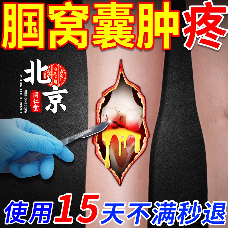 北京同仁堂膝盖后腘窝囊肿贴腿窝筋疼膝盖后窝疼鼓包肿胀抽筋伸不开蹲
