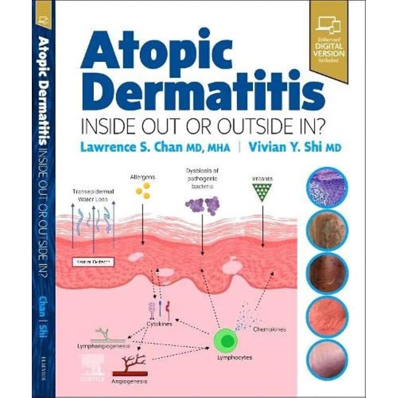 预定atopic dermatitis: inside out or outside in特应性皮炎:由内而