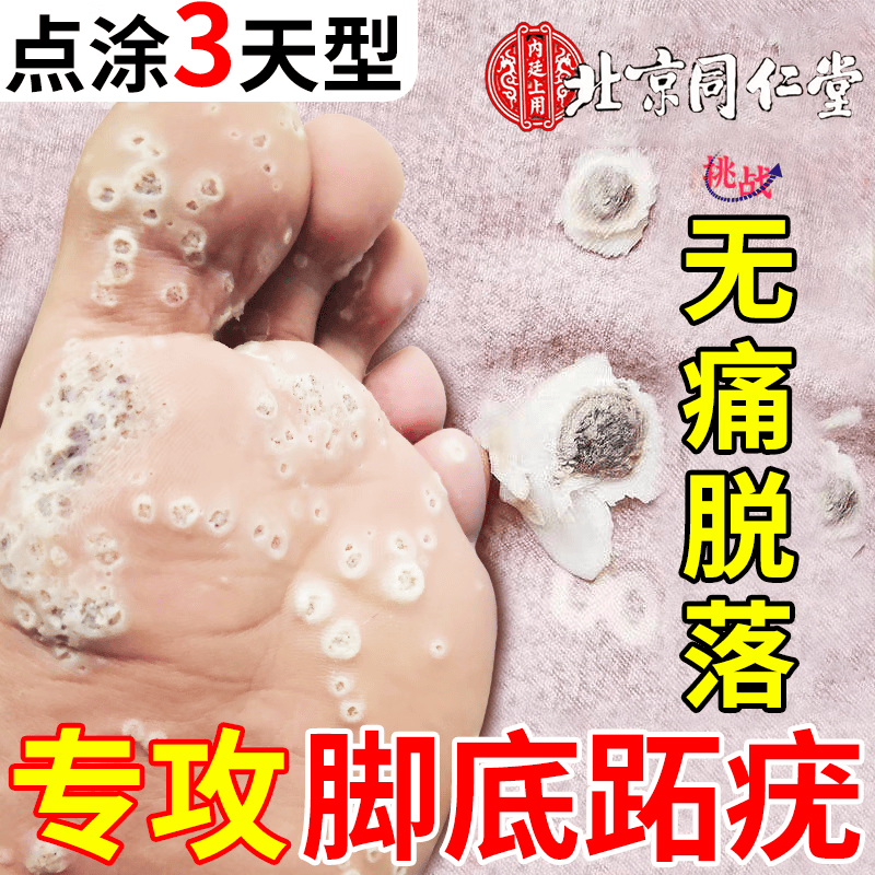 跖疣专用膏药跖疣脚底趾疣去根去足部hpv跖疣药膏跖疣贴鸡眼老茧去