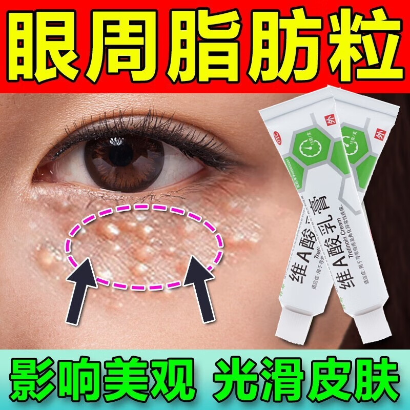 油脂粒汗管瘤眼睛周围有白色颗粒脂肪粒可选维生素e去脂肪粒专用药膏