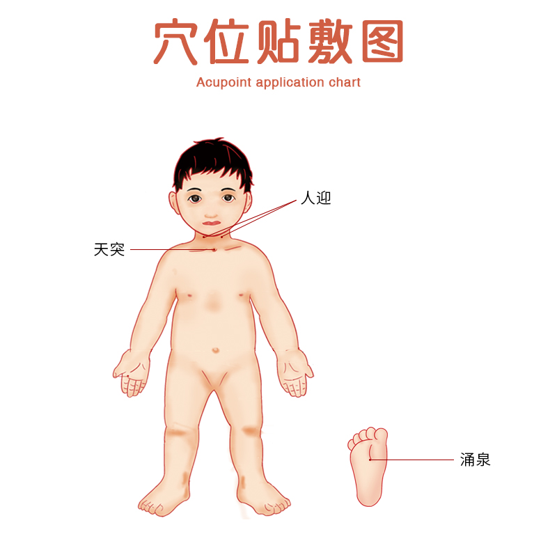 景天堂 咽扁贴儿童腺样体肥大小儿扁桃体发炎喉咙痒肿痛穴位贴 5盒【实惠装】