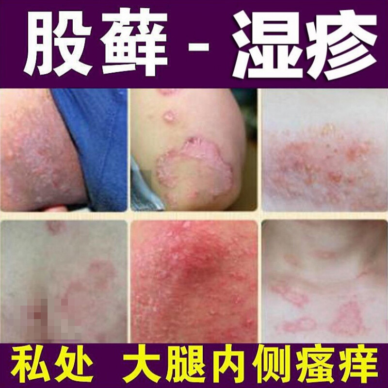 湿ii疹止痒去i根大腿内侧i股ii癣专用皮肤瘙痒外用箹i