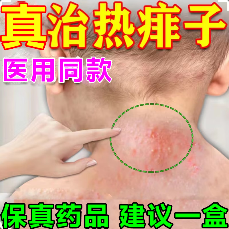 炉甘石洗剂 痱子水 痱子止痒婴儿湿疹治宝宝热痱子淹脖子后背胳膊长