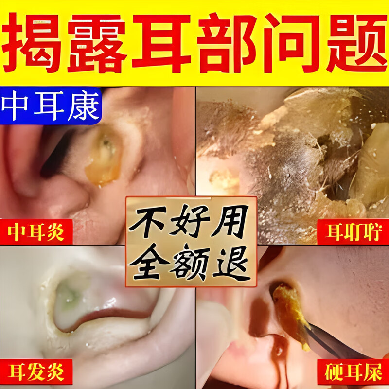 耳炎滴耳液 耳朵痒发炎 中耳炎专用真菌耳道流脓耳鸣耳痛耳膜穿孔红肿