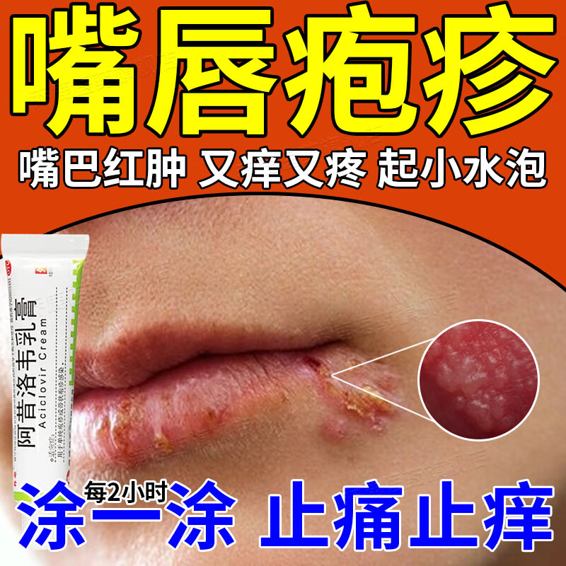 嘴唇发炎嘴角上火起泡疼痛红肿开裂脱皮烂嘴巴脓疮口唇疱疹单纯疱疹
