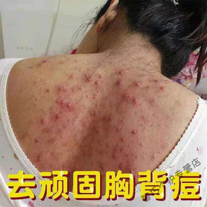 去后背痘印祛痘除螨虫祛痘訷器去痘痘印去l闭口粉刺痤l疮痘坑身上背后