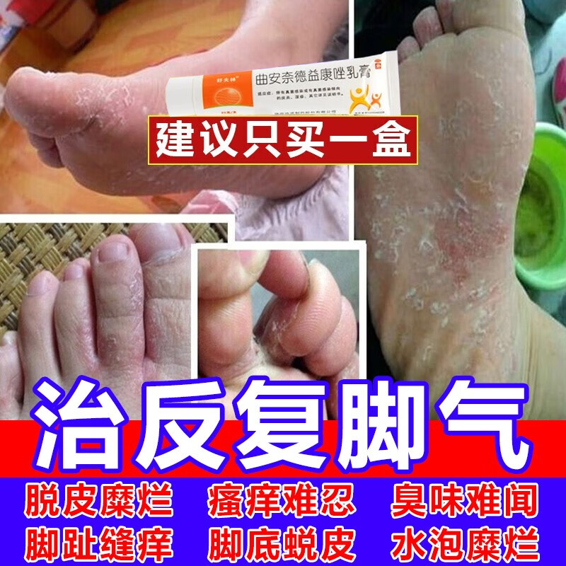咪康唑 散粉治足癣脚气的特痒止效药 脚气药止痒脱皮烂脚丫真菌感染