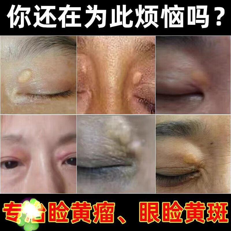 旗舰优选 治眼睑黄瘤无痛去睑黄瘤去除睑黄疣脸黄 买3贈2医师巩固装