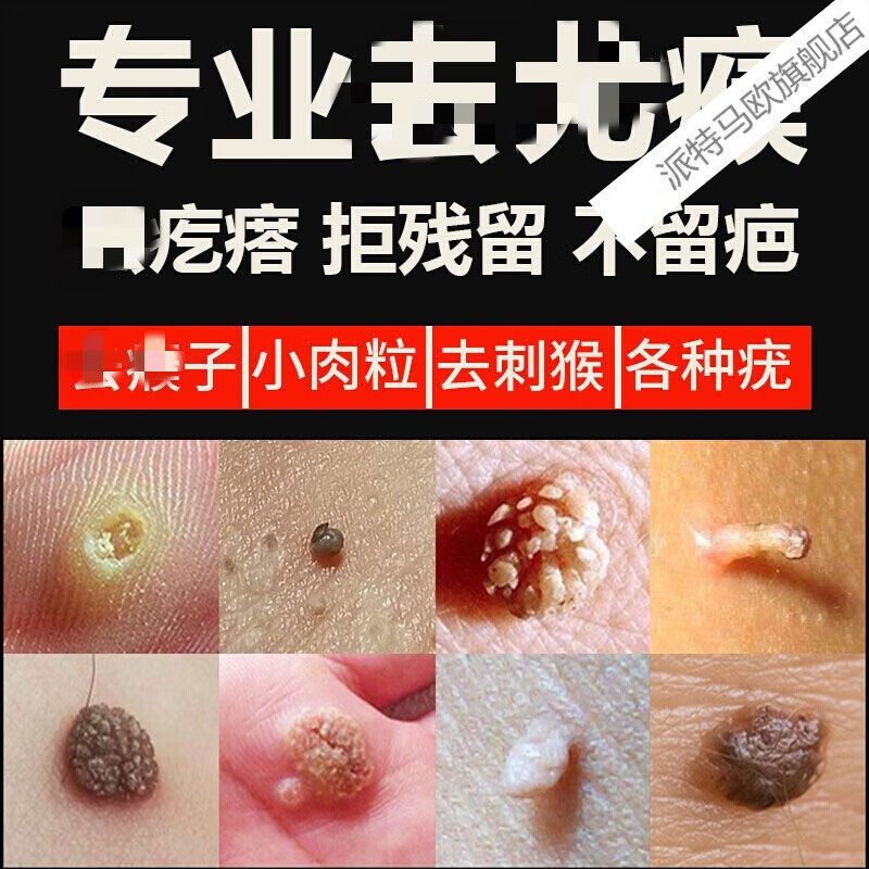 【无痛去尤】去猴子肉疙瘩小肉粒去除刺猴子瘊鸡眼膏贴液血泡刺肉血胞