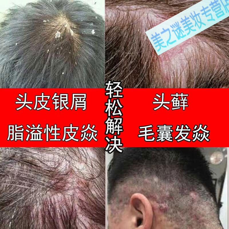 外用治撩头皮ii藓头部i藓银i屑病脂溢性皮l炎头ii藓毛囊l炎去l根除