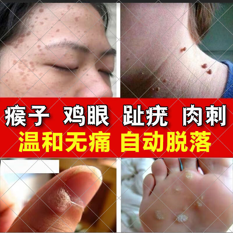 鸡眼膏去死皮老茧肉粒肉瘊i,疣i瘊灵手上脚上增生刺猴