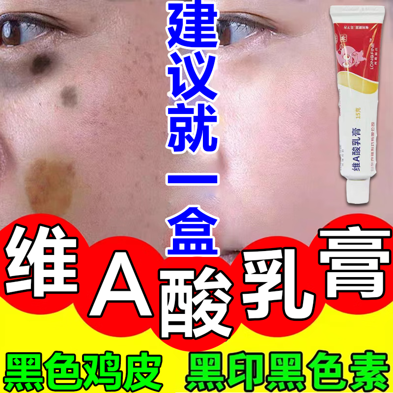 专用药化去鸡皮肤毛囊角质疙瘩大腿鸡皮肤药膏去鸡皮去黑色素沉着xh
