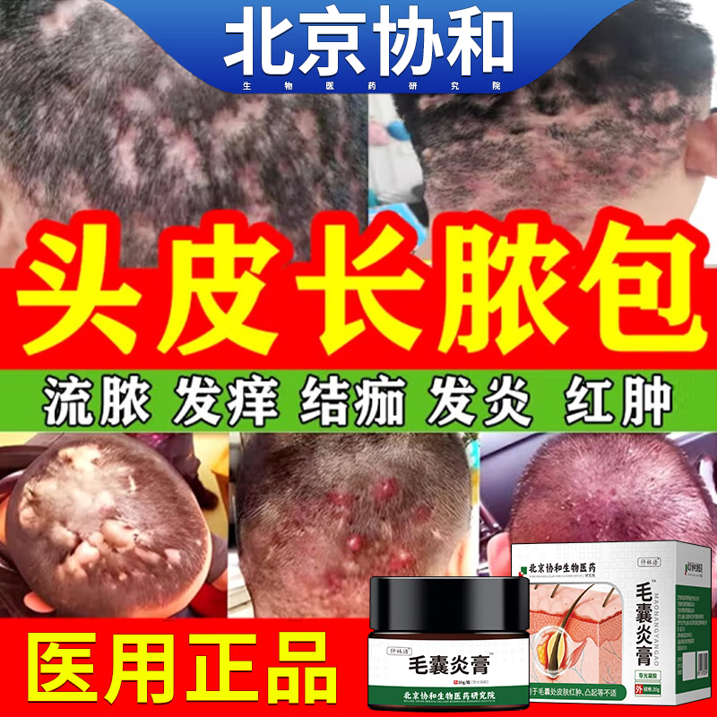 头皮毛囊炎头部专用的药监备案头上长疙瘩脓包瘙痒膏可搭治特效螨虫