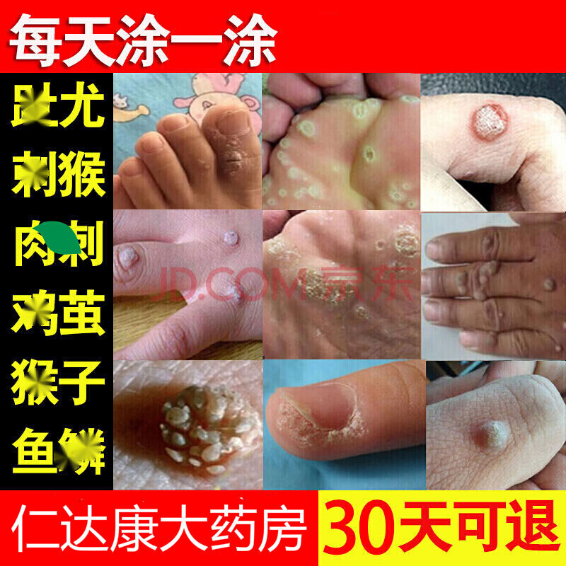 idgc官方去猴o子肉o粒疙瘩刺猴去除o猴子刺猴肉手部足部断膏跟 一盒装