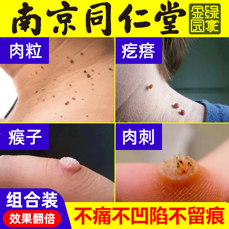 k&p去黑痣点痣水正1品点疣水克尤清刺1猴去除刺1瘊1子去除尤灵肉1刺 1