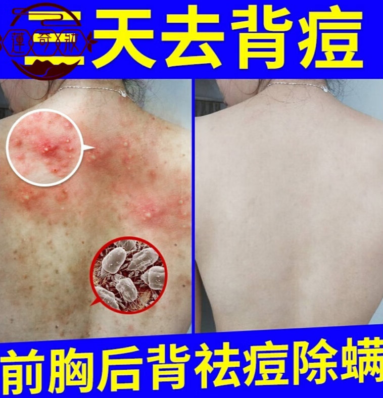 祛痘美背后背祛痘印去身上背部背上前胸口长痘痘去螨虫背部除螨皂喷雾