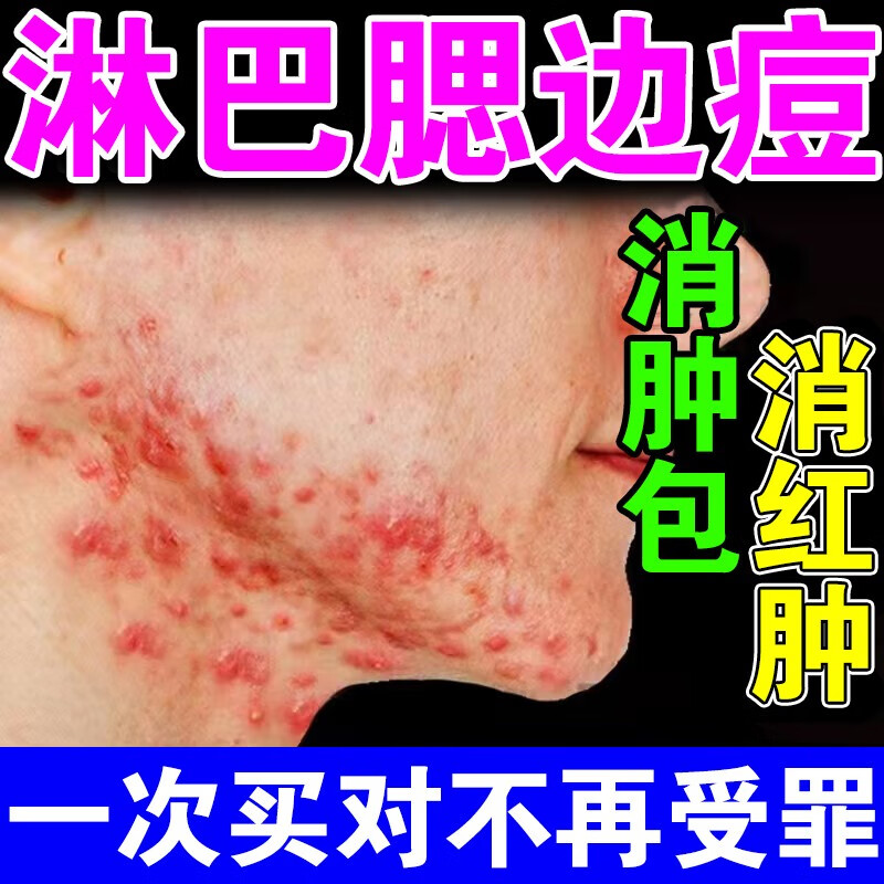 下巴红肿硬痘痘 淋巴痘腮边痘下巴反复长痘痤暗疮疮红肿结节硬块 单