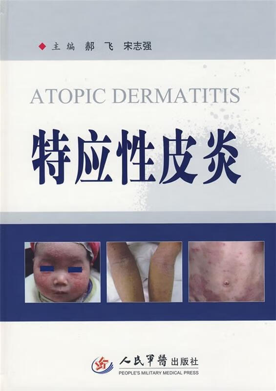 特应性皮炎【,放心购买】