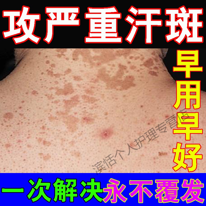 汗l斑专用箹斑藓红l斑克星白斑净香露花l斑喷剂脖子后背汗l斑去除訷器