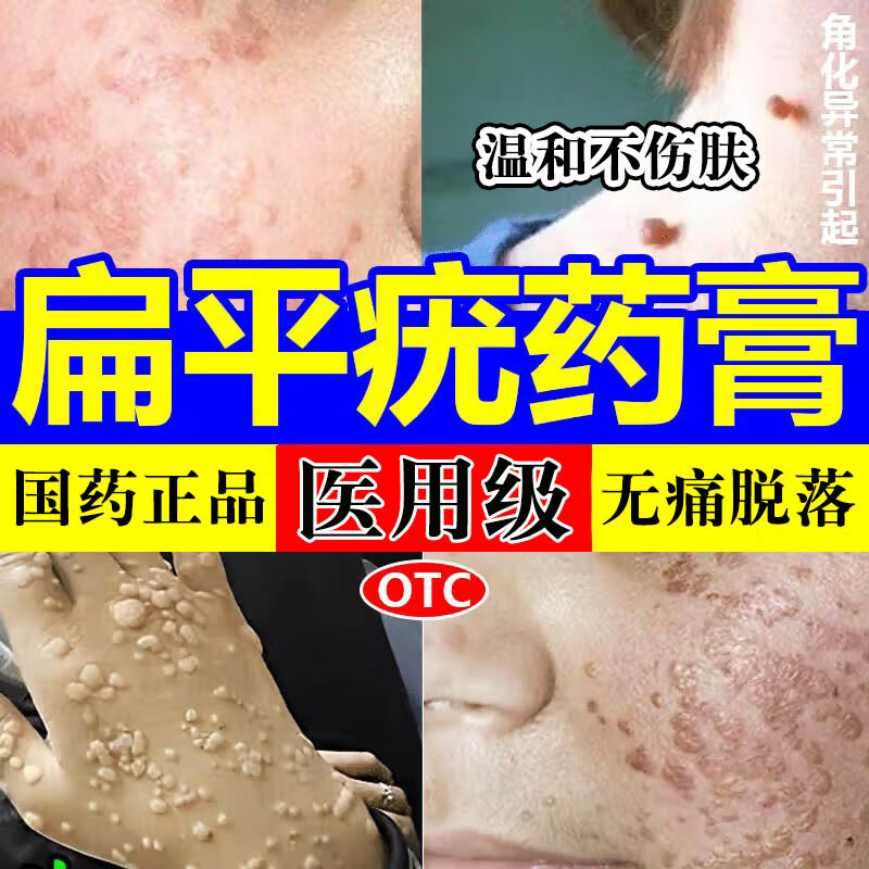 瘊子去肉刺肉粒疙瘩专用药维a酸乳膏 【体会装】1支(去疣灵毛囊角质化