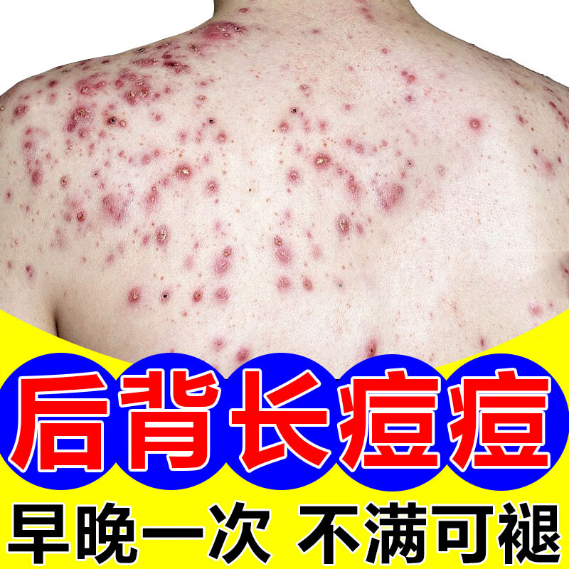背上长痘痘祛痘去除螨虫鸡皮肤湿气重前胸后背头部颈部长小痘痘丘疹