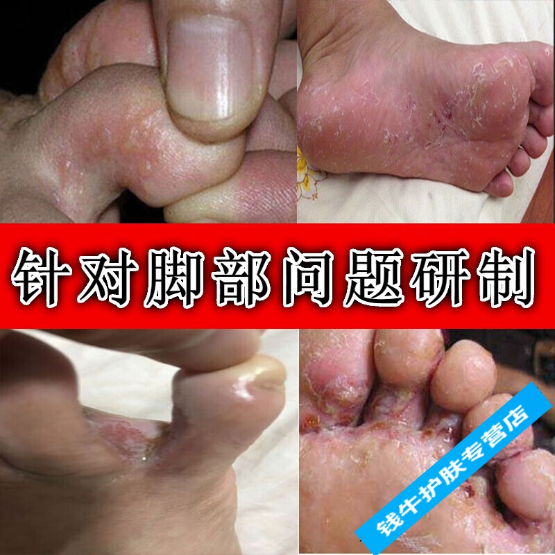 喷剂脚痒水泡脱皮脚趾缝糜烂臭汗烂i脚丫开裂脚喷剂脚痒水泡脱皮脚趾