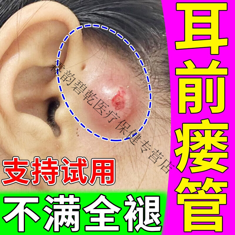 耳前瘘管炎中耳炎耳瘘封口流脓异味红肿瘙痒耳康耳 单盒[体验装]