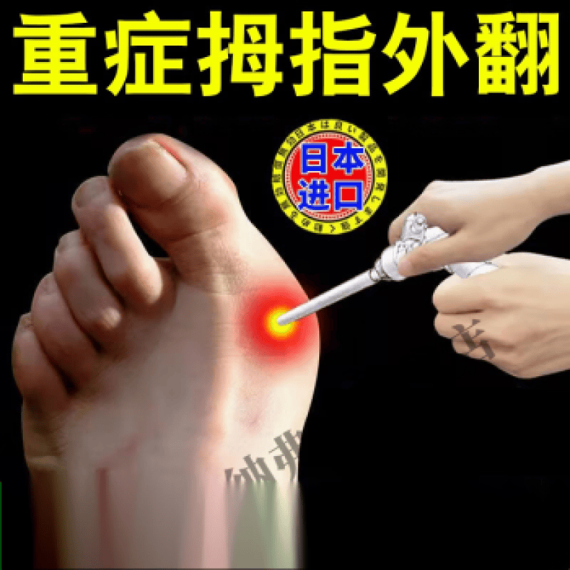 妍肤(yanfu)  严重拇指外翻器女大脚拇指外翻脚骨畸形脚趾重叠疼痛膏