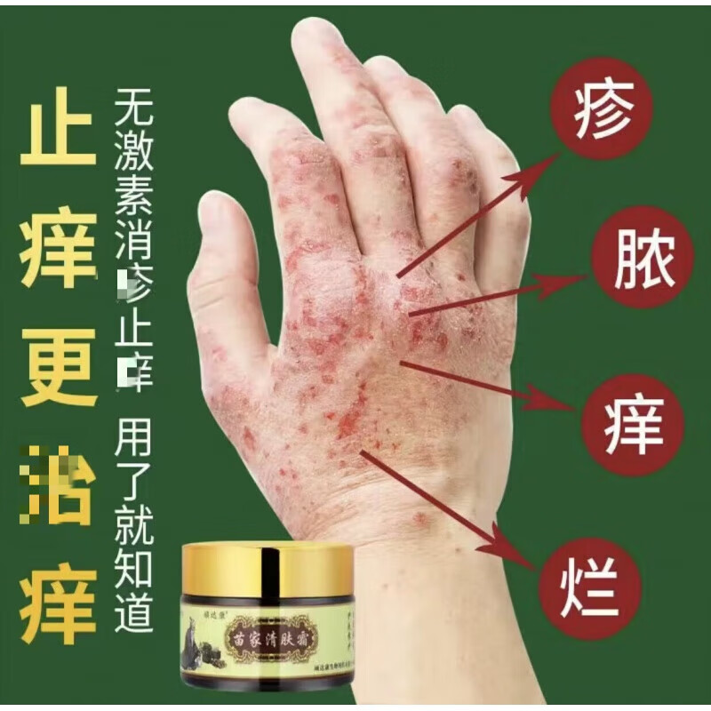 清倍康优选苗家清肤霜皮肤瘙痒膏汗去湿根成人手脚泡拔毒断痒 顽达康
