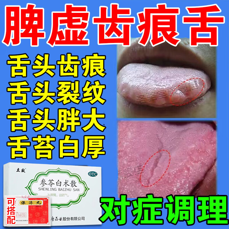 齿痕舌健脾祛湿中药调理肝郁脾虚去湿气重舌苔厚白黄腻齿痕舌成人口苦