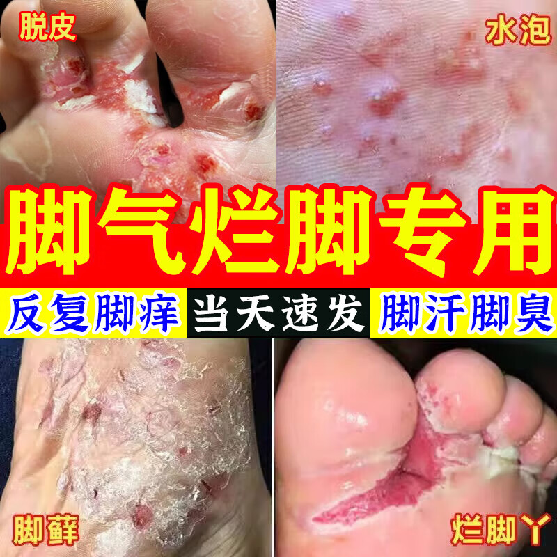 足光散治脚气泡脚汗脚臭止汗脚气药止痒脱皮烂脚丫真菌感染止痒脚特痒