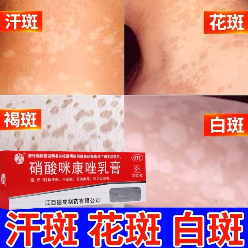 体癣股癣花斑癣真菌感染花斑癣专用药除汗斑花斑癣白斑皮肤病专用药