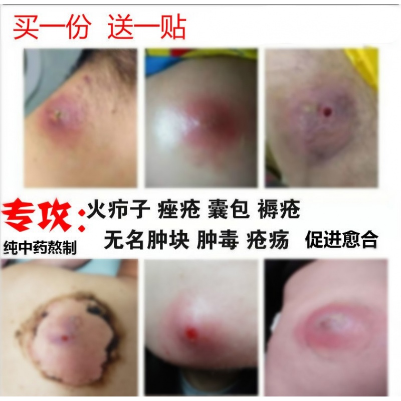 膏疖子 拔脓贴闷头火疖子坐板疮肿硬块膏贴屁股拔脓膏祛火疖子吸浓疮