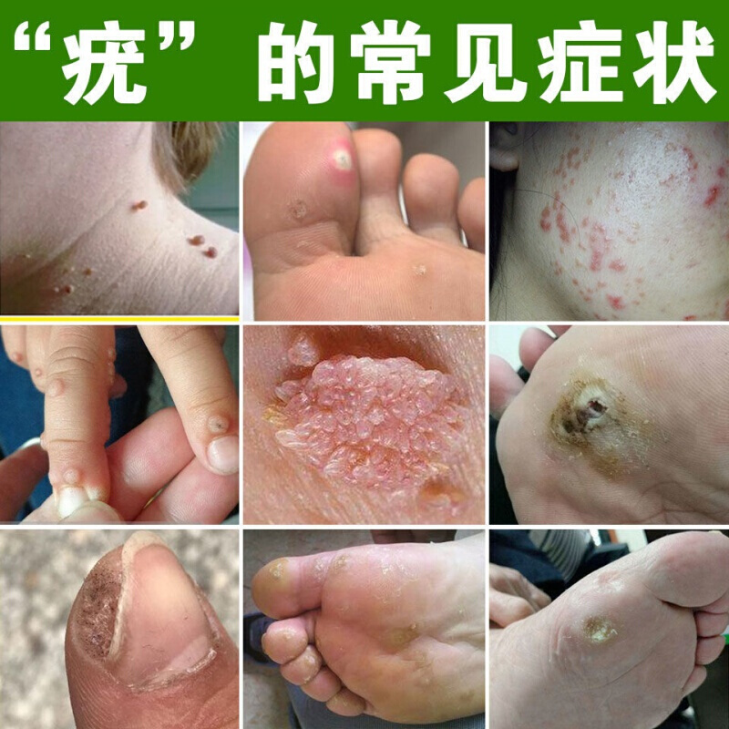 鸡眼膏贴液根手部足部跖脚底疣脚垫老茧鸡瘊刺肉猴瘊丝状扁平寻常尤疣