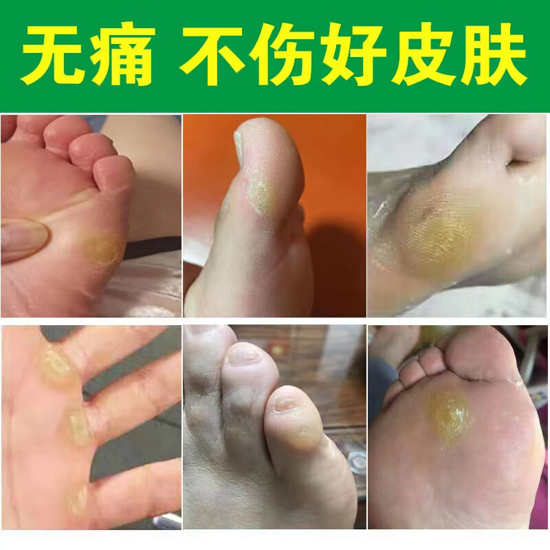 新品 脚钉祛除膏脚底根厚脚垫老茧鸡茧洁士胼胝贴硬死皮脚丁软化剂