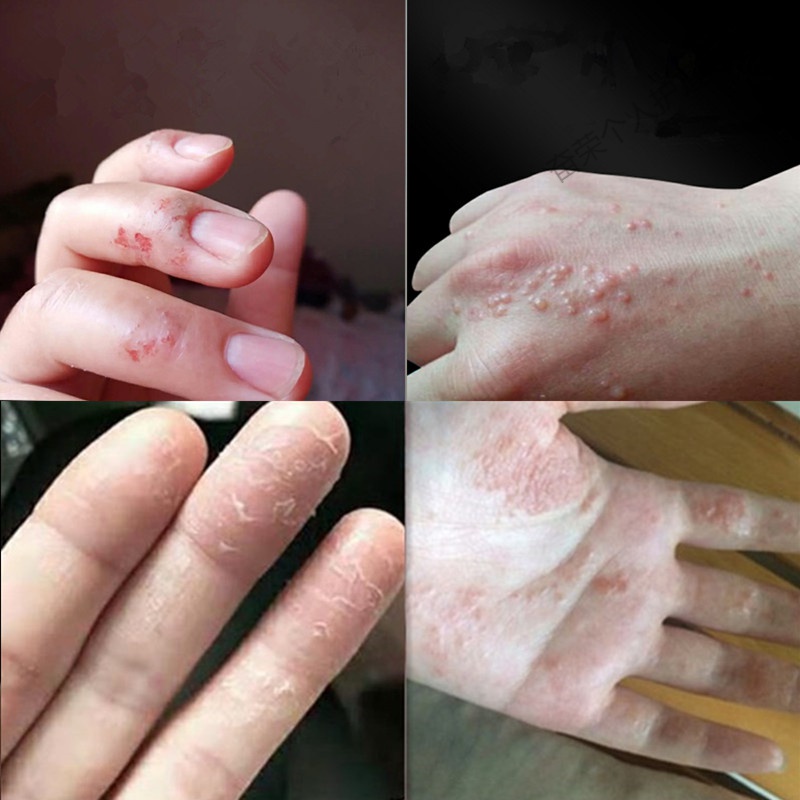 手蜕皮季节性手上癣膏脱皮真菌感染去i根开干裂水泡鹅掌风手脚足i藓